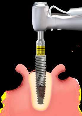 Instalação do implante com o contraângulo As instruções a seguir apresentam o passo a passo do manuseio do implante Grand Morse Neodent para instalação com o contraângulo.