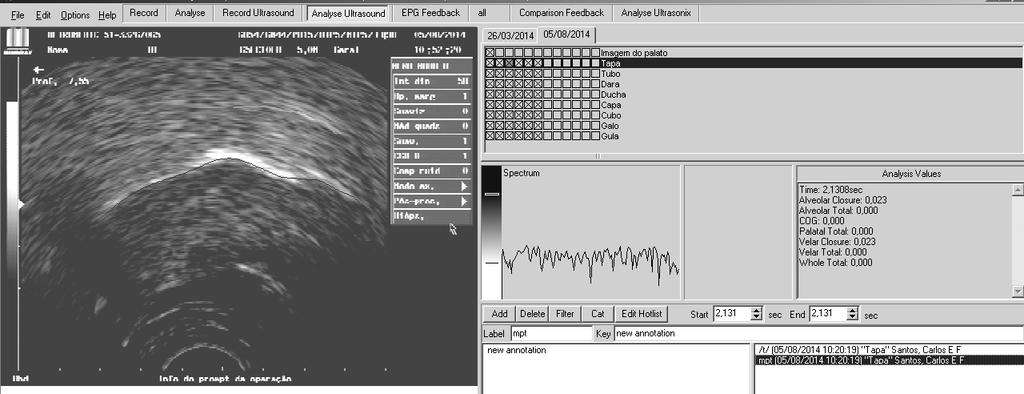 A ultrassonografia e a terapia de fala 289 (em corte sagital) no instante correspondente ao ponto médio da consoante.