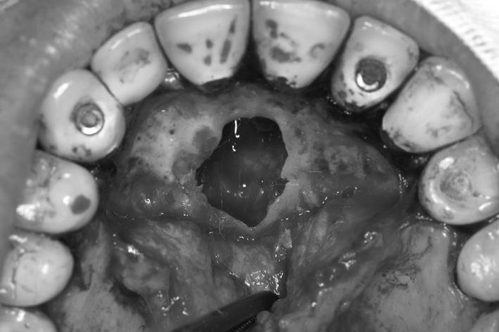 A peça cirúrgica apresentava FIGURA 5: Fotomicrografia evidenciando cavidade cística delimitada por epitélio. HE-100X.