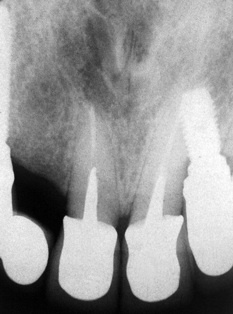 Cisto do ducto nasopalatino em intima relação com implante osseintegrado FIGURA 7: Aspecto radiográfico pós-operatório de dois anos.