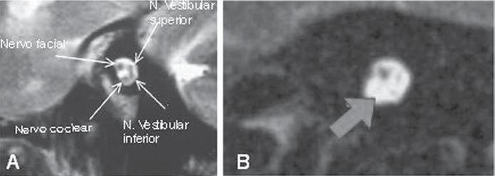 Figura 4. Imagens sagitais de RM ponderadas em T2. A: Distribuição anatômica dos nervos no interior do canal auditivo interno. B: Ausência do nervo coclear (seta).