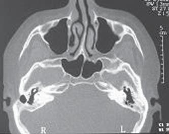 cocleostomia (Figura 5) (6,9).