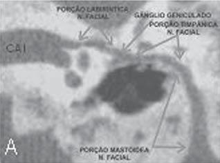 Figura 8. Cortes tomográficos axiais. A: Opacificação total de células mastoideas à esquerda, associada a esclerose de septos ósseos.