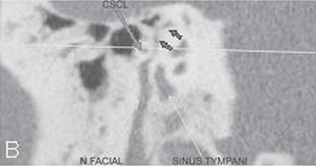 Corte tomográfico axial. Desmineralização óssea pericoclear bilateral (otosclerose retrofenestral). Figura 11. Imagem tomográfica axial.