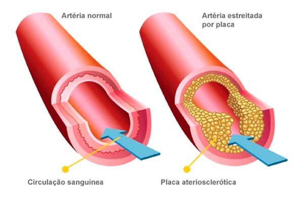 HIPERCOLESTEROLÉMIA FAMILIAR O QUE É?