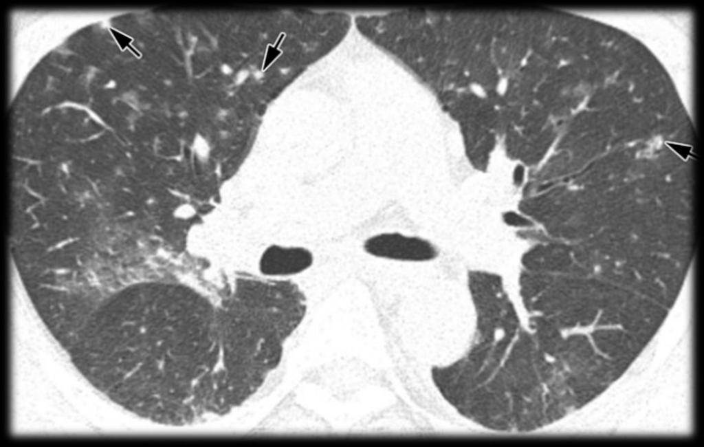 Pneumonia por Varicela