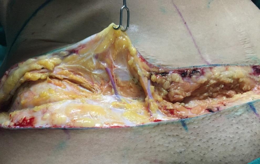 Ilíaca Circunflexa Superficial do abdome (C) AICS sub fascial