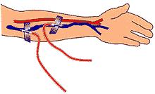 ACESSO VASCULAR: O acesso vascular é a linha de vida do paciente, deve ser preservado,