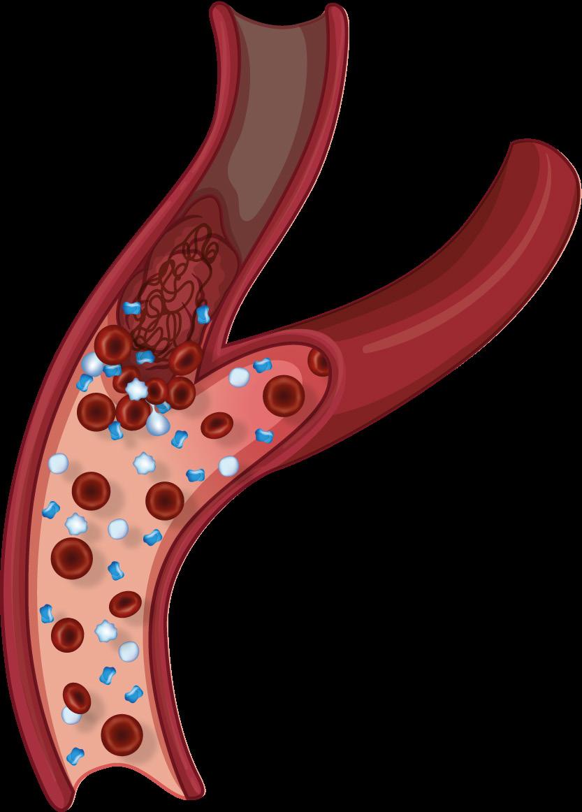 Capítulo 1 DEFINIÃO DO AVC E SUA CLASSIFICAÇÃO O Acidente Vascular Cerebral (AVC) é definido por uma lesão tecidual secundária à vascularização insuficiente, levando, por sua vez, a um infarto