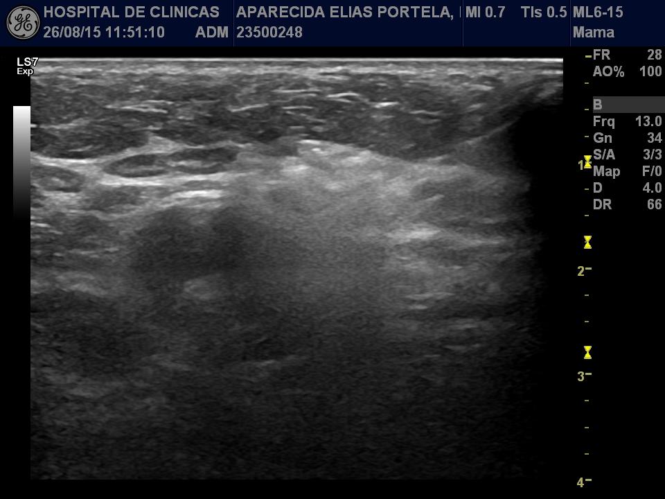 31 FONTE: Serviço de Radiologia do Hospital de Clínicas - UFPR. ia Na sequência, as pacientes eram encaminhadas ao serviço de oncologia clínica para quimioterapia neoadjuvante de acordo com protocolo.