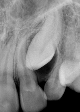 observaram que sua ausência na dentadura permanente está relacionada diretamente com a impactação, já que a agenesia dos mesmos quase nunca é observada.