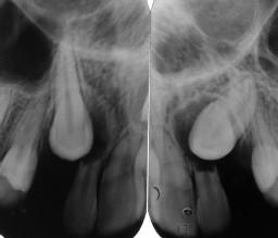 Fonte: Almeida (2001). As radiografias periapicais (Fig. 4) associada ao exame clínico são suficientes para determinar a posição exata dos caninos em 92% dos casos.