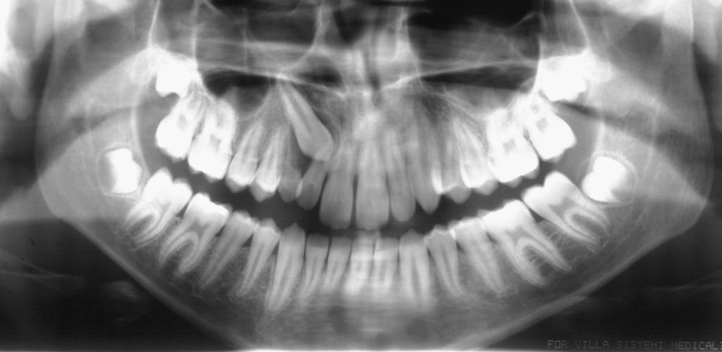 (Fig. 5). C. Radiografia panorâmica Figura 5 - Radiografia oclusal. Fonte: Marchioro (2002).