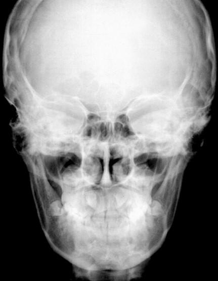 Teleradiografia em norma lateral e frontal As telerradiografias em norma lateral (Fig.