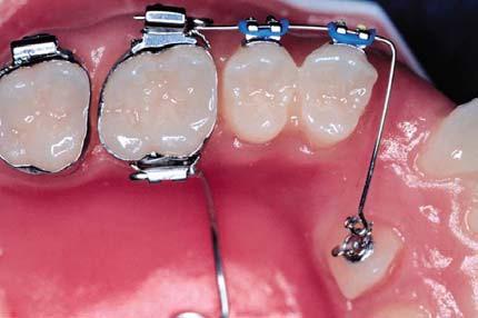 soldada às bandas dos pré-molares. (JACOBY, 1979). A mola Ballista pode ser confeccionada com fio de aço inoxidável.014,.016 ou.