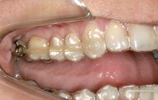 Porém, é importante ressaltar que esse é o resultado do planejamento virtual, e não do tratamento. Assusta-me ver que muitos ortodontistas prometem isso a seus pacientes.