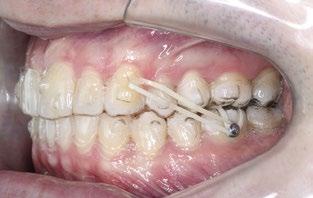 No entanto, muitos ortodontistas afirmam, e a literatura mostra, que cerca de 70% a 80% dos casos necessitam de mudanças, refinamentos ou até mesmo conversão para aparelhos fixos antes do fim do