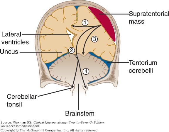 Hipertensão intracraniana PIC normal é em torno de 10 mmhg.