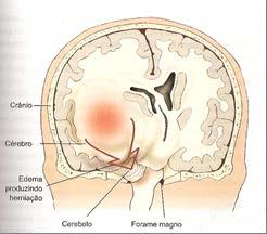 Importante O crânio é uma grande estrutura óssea que abriga o cérebro.