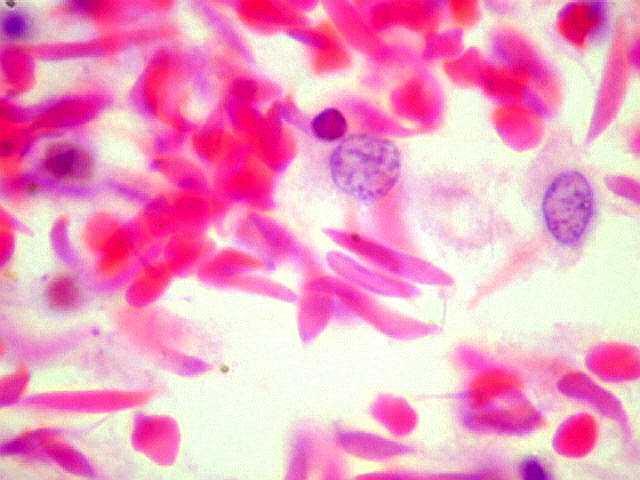 As hemoglobinas A (HbA) e fetal (HbF), mesmo em concentrações elevadas, não formam estruturas organizadas dentro das hemácias, quando