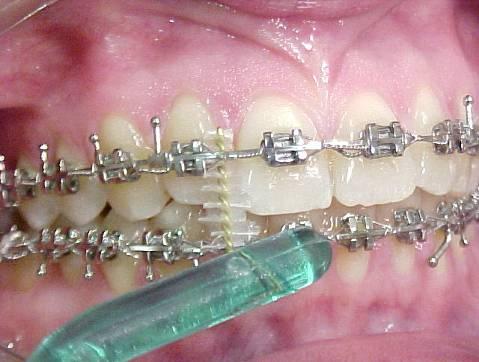 2 Evidenciadores (figura 11) Figura 10. Escovas unitufos auxiliam na escovação em pacientes com aparelhos ortodônticos.