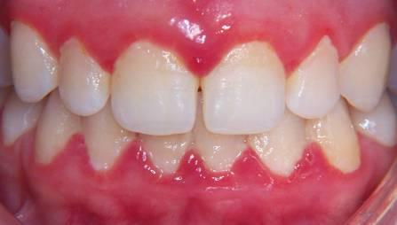 2. PLACA BACTERIANA OU BIOFILME DENTAL A placa bacteriana ou biofilme é uma camada gelatinosa, incolor, rica em microorganismos e seus produtos que aderem naturalmente à superfície dos dentes