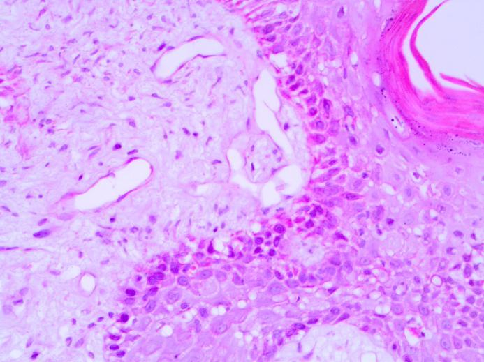 O animal foi encaminhado para biópsia cutânea e os achados encontrados foram de extensa área de degeneração das células basais, intensa eosinofilia (Figura 3), apoptose de múltiplas células (Figura