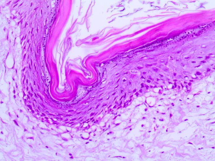 Esses achados são característicos de lúpus eritematoso (Anexo 1). Figura 3: Fotomicrografia da pele de cão, fêmea, SRD, sete meses de idade, com lúpus eritematoso sistêmico.