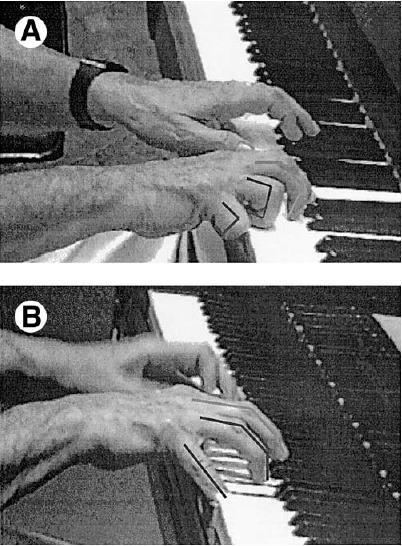 focal hand dystonia in musicians