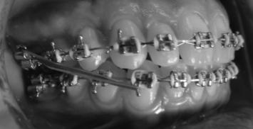 Força contínua Mantida razoavelmente constante entre uma sessão clínica ( t1 ) e outra ( t2 ). Eemplo: arcos de nivelamento.