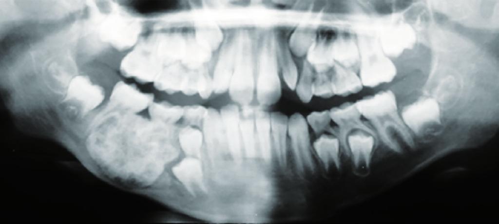 Semiologia FIGURA 1 Exame intraoral da paciente 1: massa endurecida envolvendo o corpo mandibular direito, recoberta por mucosa normal e com apagamento do fundo de sulco FIGURA 4 Paciente