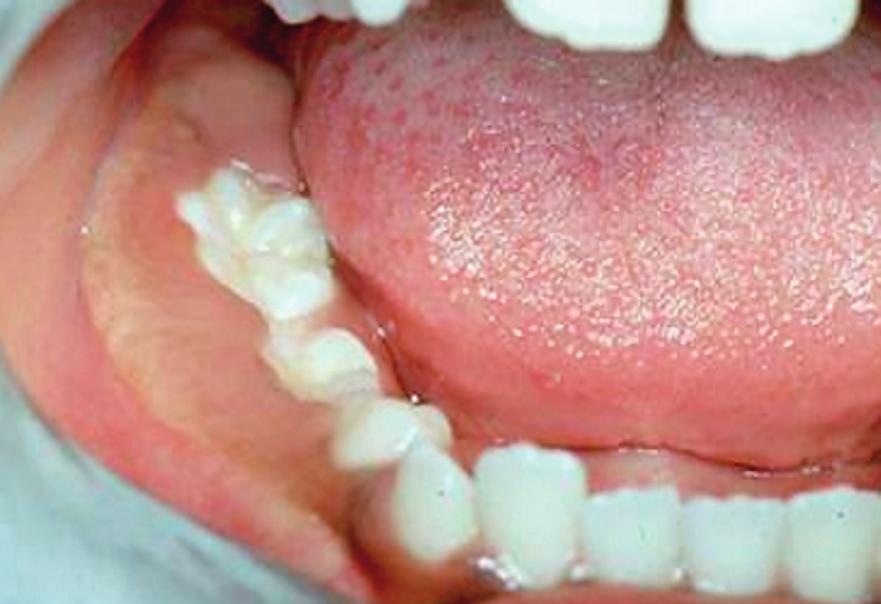 12 Alguns casos podem levar à fratura mandibular ou parestesia do lábio inferior.