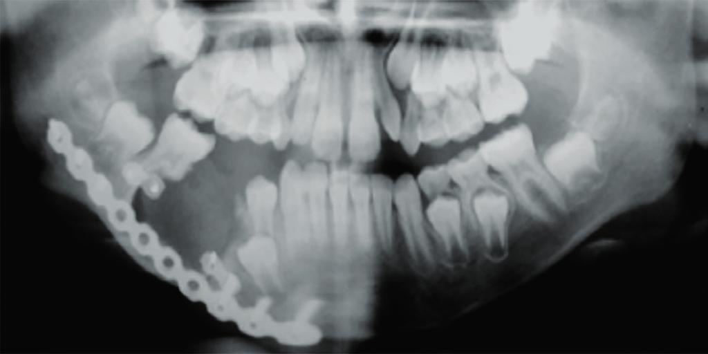 não é possível visualização de limite entre a raiz dentária e a lesão FIGURA 9