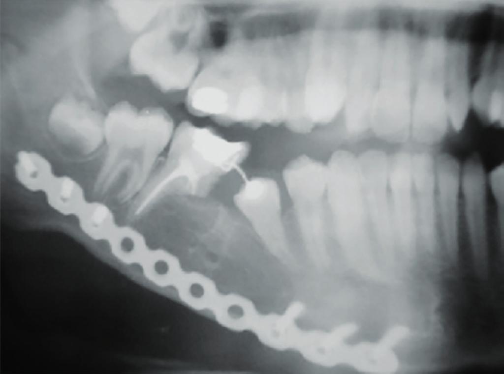 molares decíduos, este envolvido por massa acastanhada FIGURA 7 Radiografia