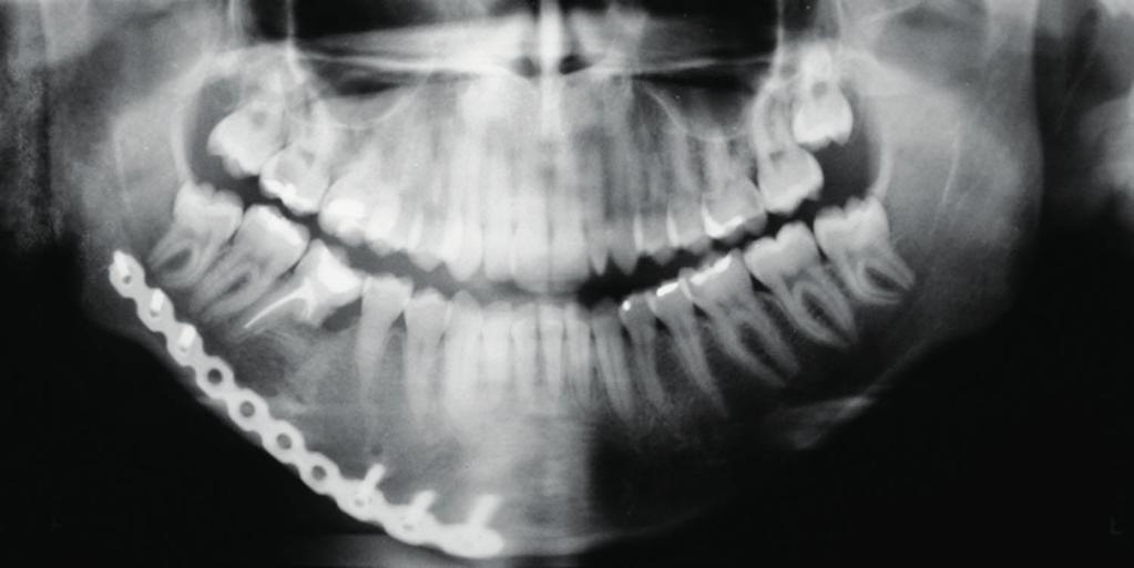 lesão e oclusão dental aceitável FIGURA 8 Pós-operatório de 1 ano do paciente