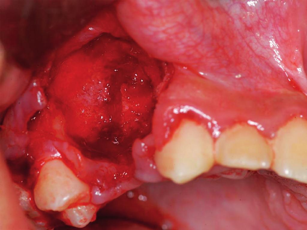cirúrgica após remoção do bloco dente-lesão do paciente 8 Artigo 12 -