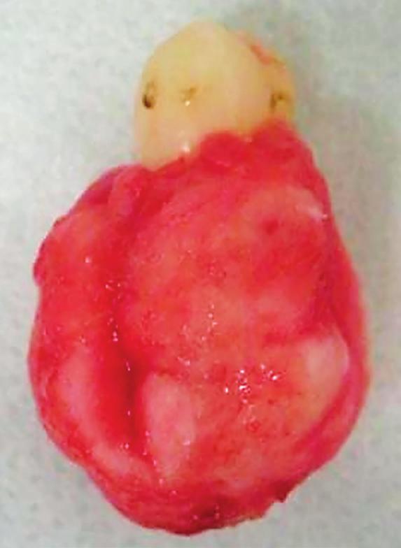 Semiologia FIGURA 15 Paciente 8: Secção do bloco dente-lesão: note reabsorção da raiz vestibular e perda do espaço do ligamento periodontal da raiz palatina FIGURA 12 Espécime