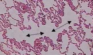 Ductos Alveolares H.