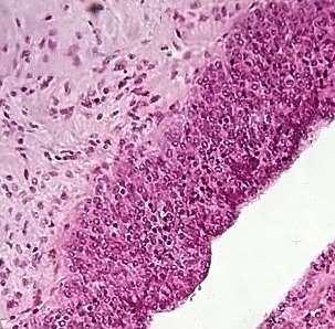 Parte intermediária (ADI) (glândula endócrina cordonal e folicular -