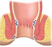 LESÃO HPV PERIANAL E ANAL INTRODUÇÃO Os cânceres anais podem ocorrer na borda anal ou no canal anal, até a transição com o reto (figura1).