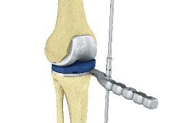 12. implantes de PRovA A prótese femoral de prova é introduzida com o suporte de implante do fêmur e alinhada médio lateralmente.