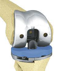 AESCulAP ColumBuS StREAmlinEd ARtRoPlAStiA de JoElho 16. PRótESE PS de PRovA Para a versão PS, a prótese femoral de prova apropriada é conectada à caixa femoral PS e implantada.