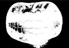 FIGURA 9 A placa bacteriana (*) Quando nos alimentamos, os dentes ficam sujos. Por isso devemos Outro forma de visualizá-la é com o uso de corantes. Esse método é mais utilizado pelos dentistas.