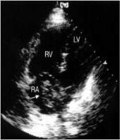 probabilidade confirma TEP RX tórax normal: cintilografia