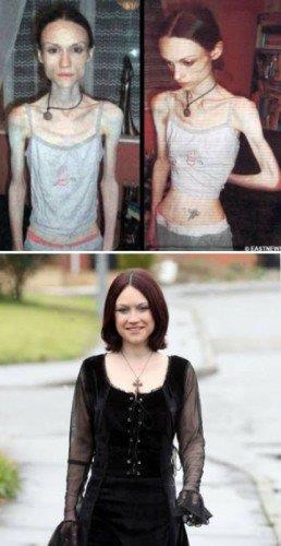 Anorexia A garota anoréxica que caminha 12 horas por dia para perder peso A mulher de 26 anos, que chegou a