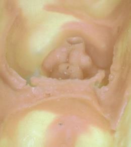 Rasgamento Rasgamento ou rompimento do material de moldagem resulta em uma reprodução imprecisa do sulco e superfície do dente, ou em uma preparação similar aos espaços vazios e as saliências.