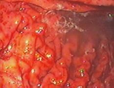 Gastropatia Hipertensiva Portal Tratamento Gastropatia hipertensiva Portal