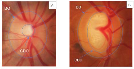 3.1. Base de Imagens Nesta pesquisa utilizou-se a base de imagens pública RIM-ONE [Trucco et al. 2013], que é disponibilizada gratuitamente e é formada por três versões diferente.