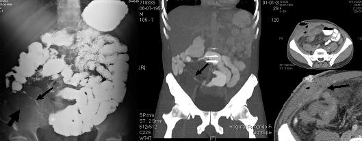 A B CC Fig. 4 Doença de Crohn do íleon distal em fase activa. A Padrão em pedra de calçada da última ansa ileal (trânsito seriado do delgado).