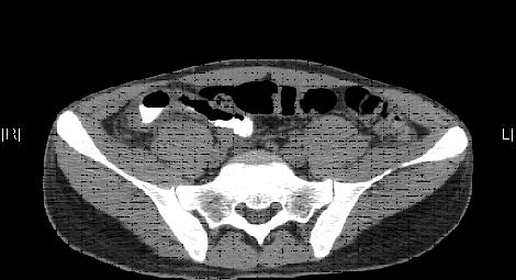 5 Doença de Crohn do íleon distal em fase activa. A Sinal da corda (seta fina) e trajecto fistuloso êntero-cutâneo (seta grossa) (trânsito seriado do intestino delgado).
